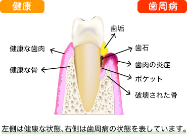 歯周病とは